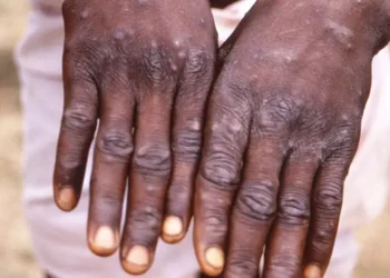 SITUATION DE LA VARIOLE SIMIENNE : 14 700 cas confirmés dont 66 décès en Afrique