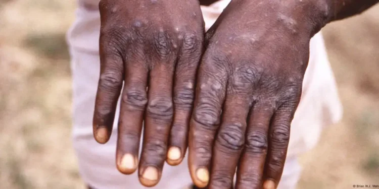 SITUATION DE LA VARIOLE SIMIENNE : 14 700 cas confirmés dont 66 décès en Afrique