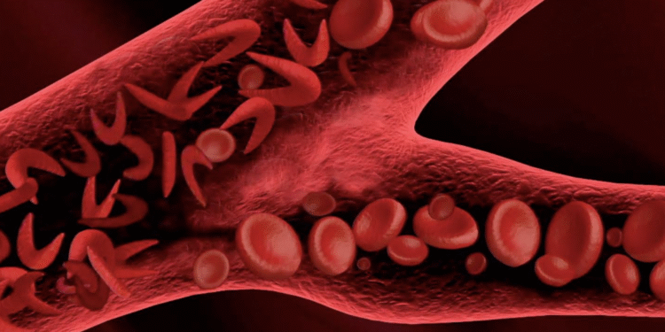 GROSSESSE CHEZ LES FEMMES DRÉPANOCYTAIRES : Le taux de mortalité maternelle 4 à 11 fois plus élevé que chez les non-victimes
