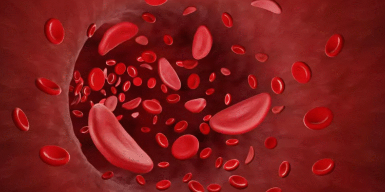 DRÉPANOCYTOSE : Environ deux millions de personnes touchées au Sénégal