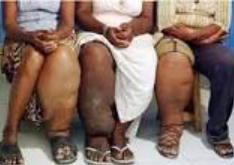 LUTTE CONTRE LA STIGMATISATION ET LA DISCRIMINATION : Vers l’intégration des soins de santé mentale dans la prise en charge des Mtn